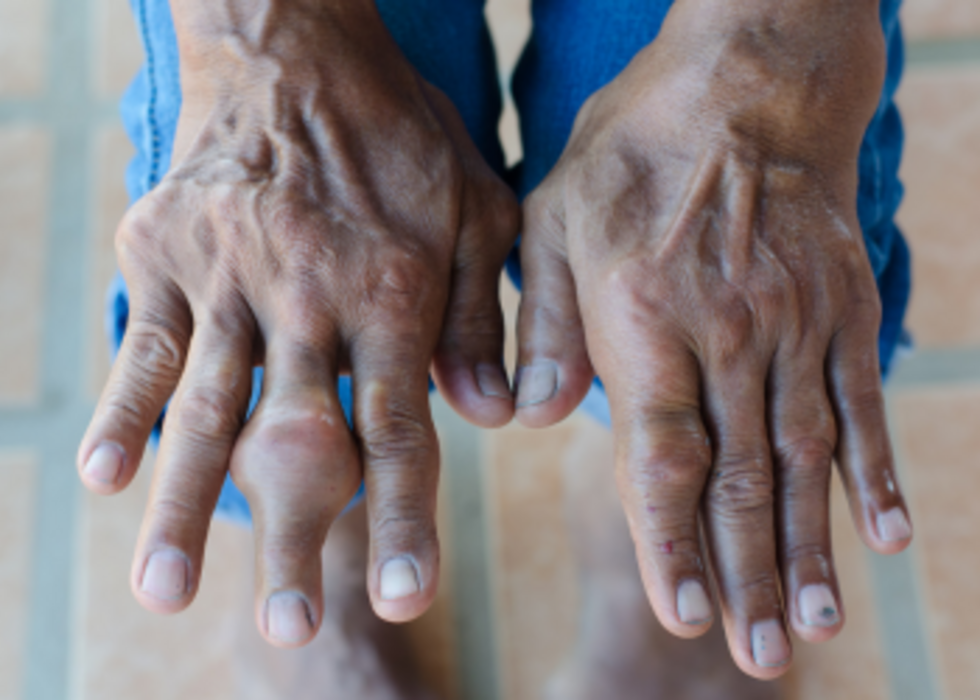 Treatment of hyperuricemia &amp; Gout