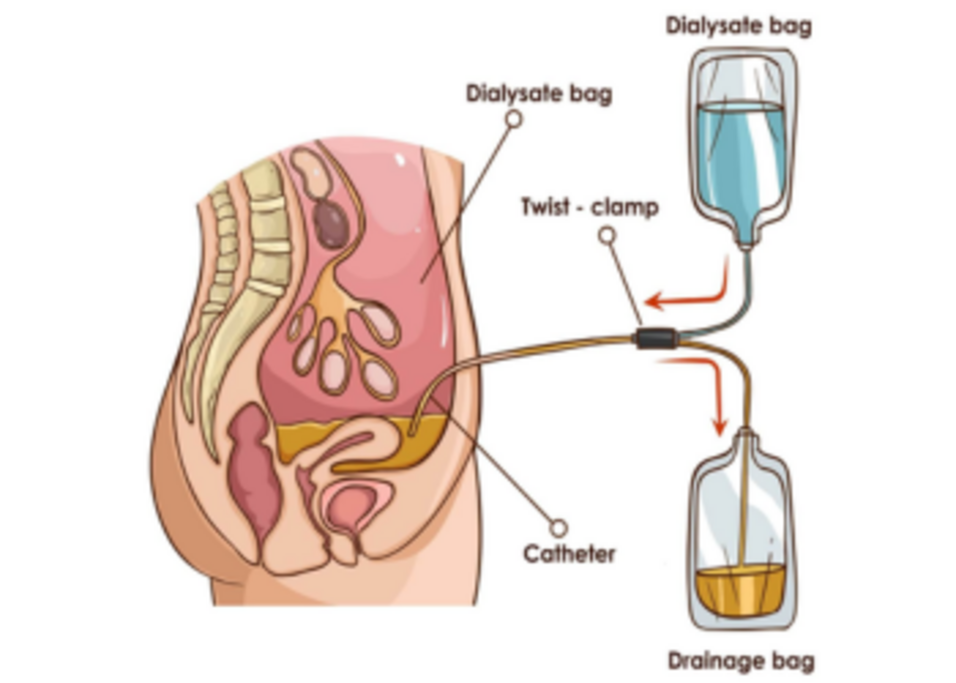 Peritoneal dialysis